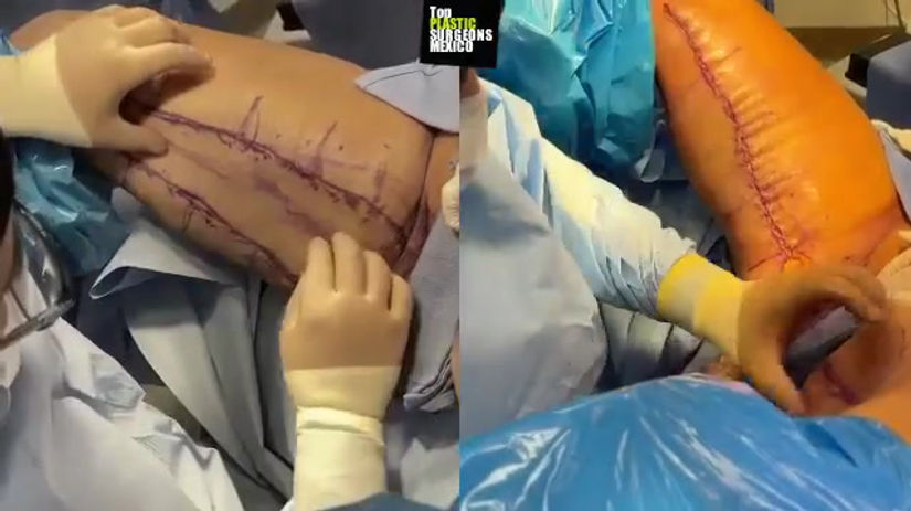 THIGHPLASTY + INNER THIGH LIPOSUCTION